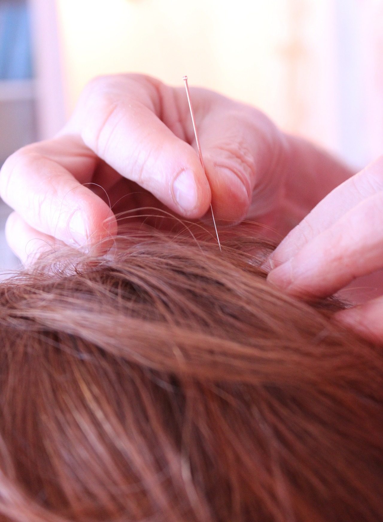 acupuncture-656578_1920 acupuncture-656578_1920